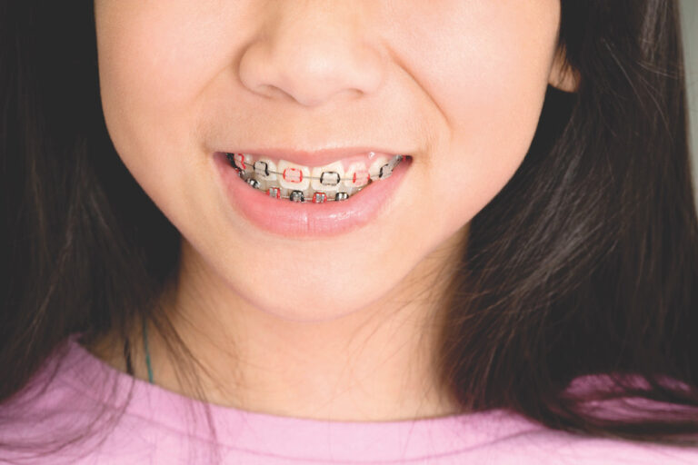 How To Personalize Your Braces Charleston Orthodontics Powered By