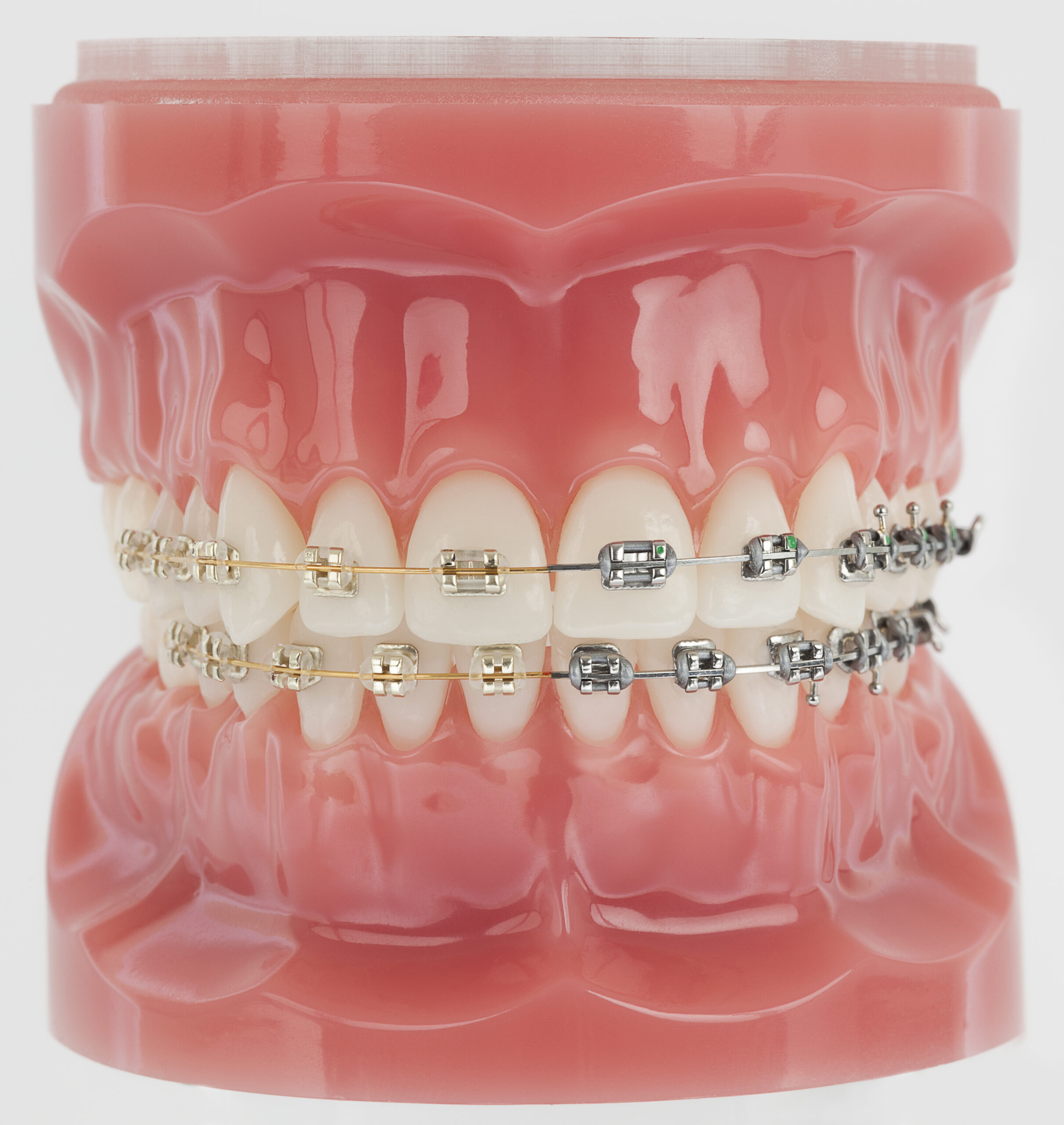 Different Types of Braces: Silver & Gold Traditional braces