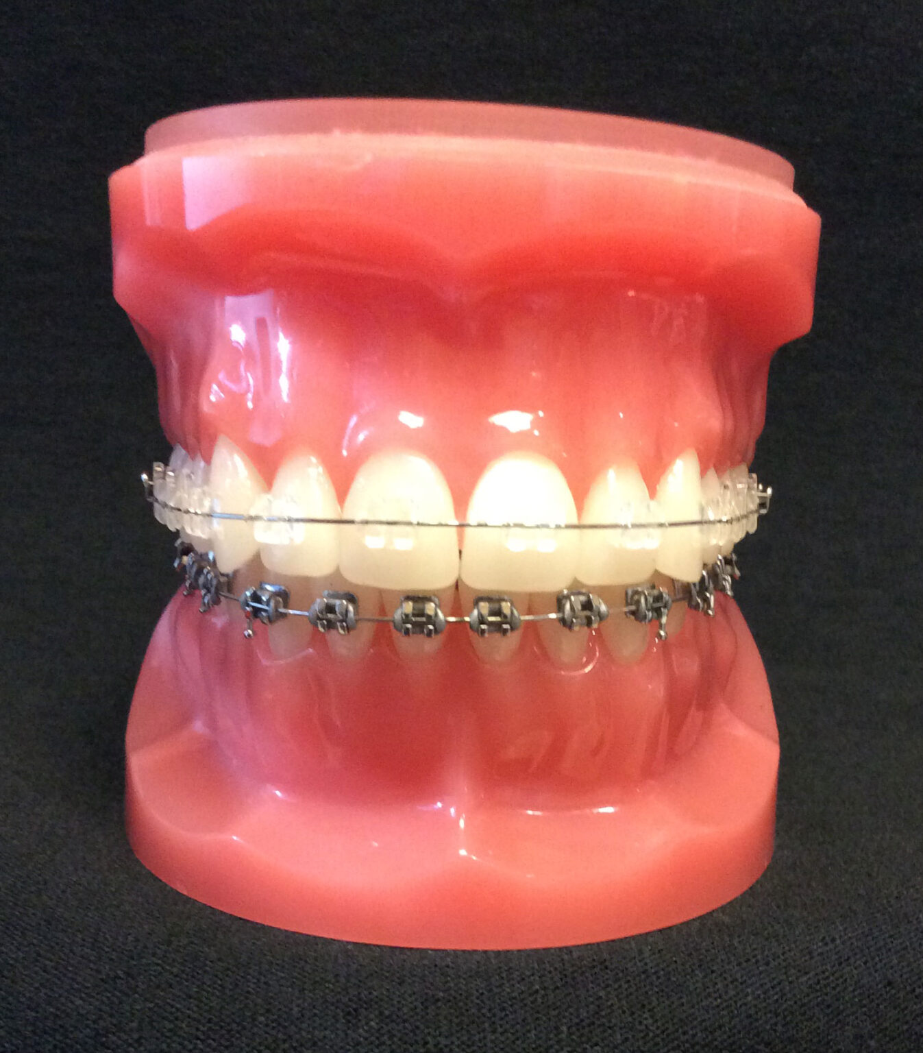 Types of Braces Ceramic Braces Charleston Orthodontic Specialists