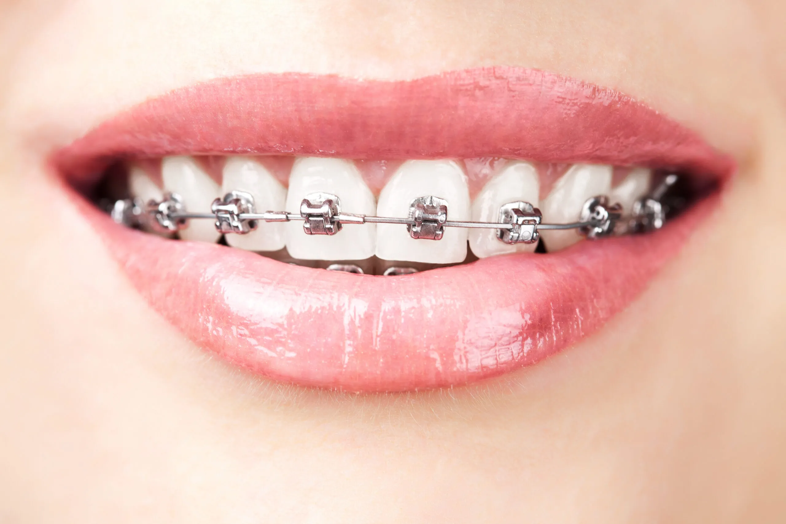 braces close look up