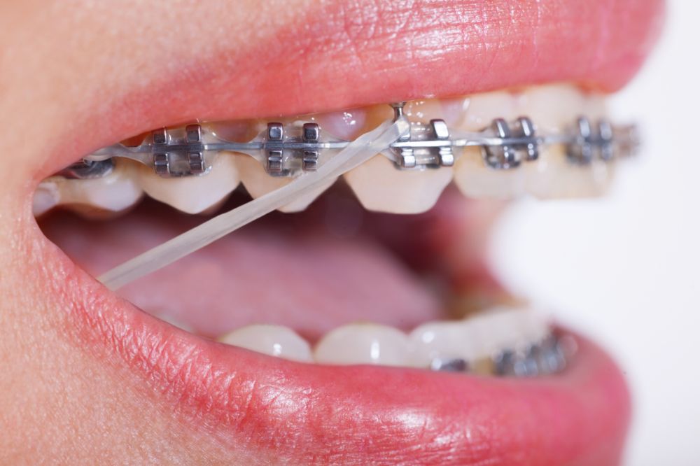 Braces with Rubber bands