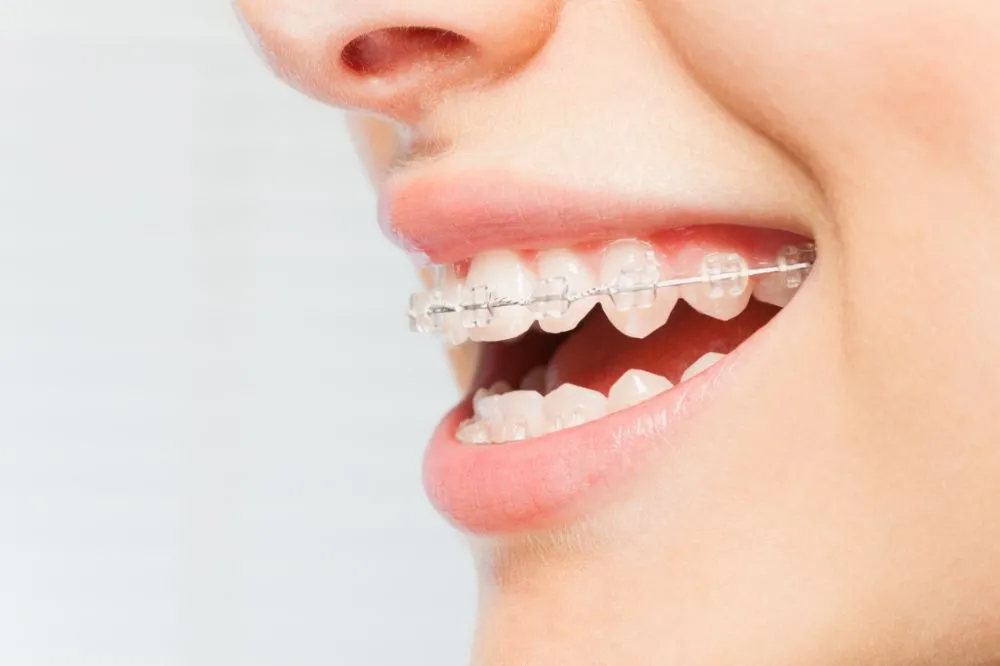 Close up look of braces