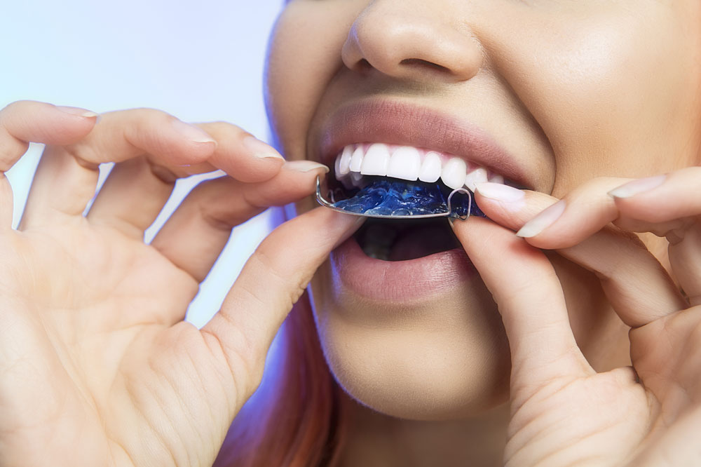 Do You Have To Replace Permanent Retainers