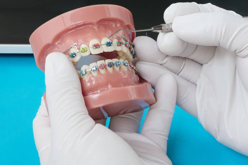 tooth dental braces