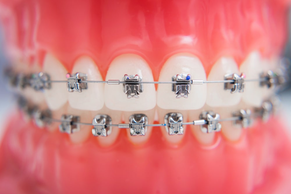 dental braces model