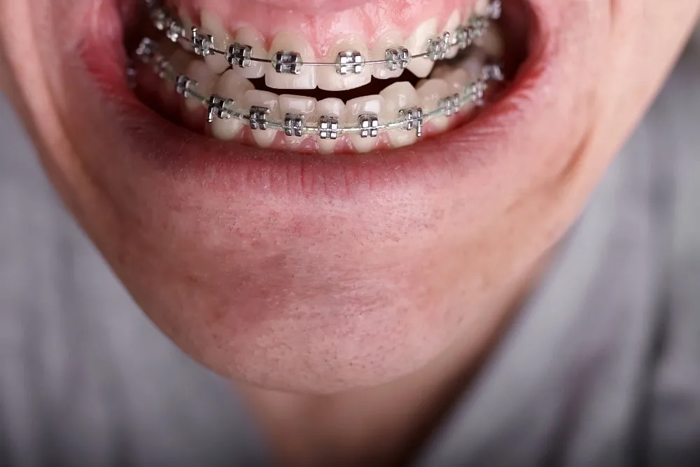 close lookup braces
